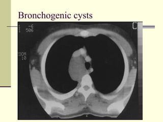 Bronchogenic cysts 