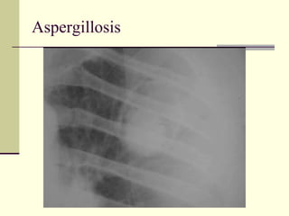Aspergillosis 