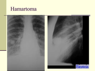 Hamartoma 