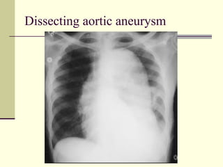 Dissecting aortic aneurysm 
