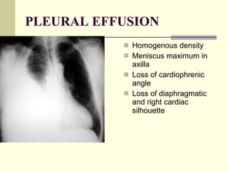 PLEURAL EFFUSION Homogenous density  Meniscus maximum in axilla  Loss of cardiophrenic angle  Loss of diaphragmatic and right cardiac silhouette  