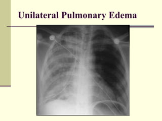Unilateral Pulmonary Edema 