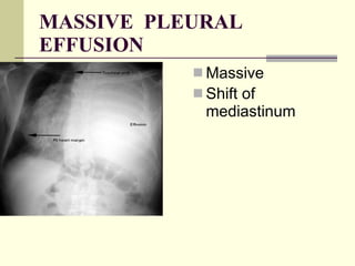 MASSIVE  PLEURAL EFFUSION Massive  Shift of mediastinum   