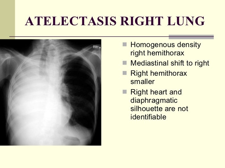 What is lung nodular density and atelectasis?