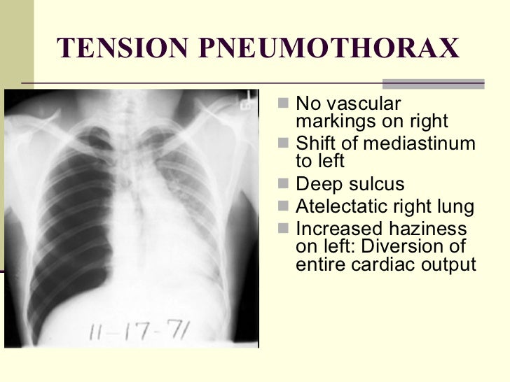 Image result for pneumothorax x ray findings