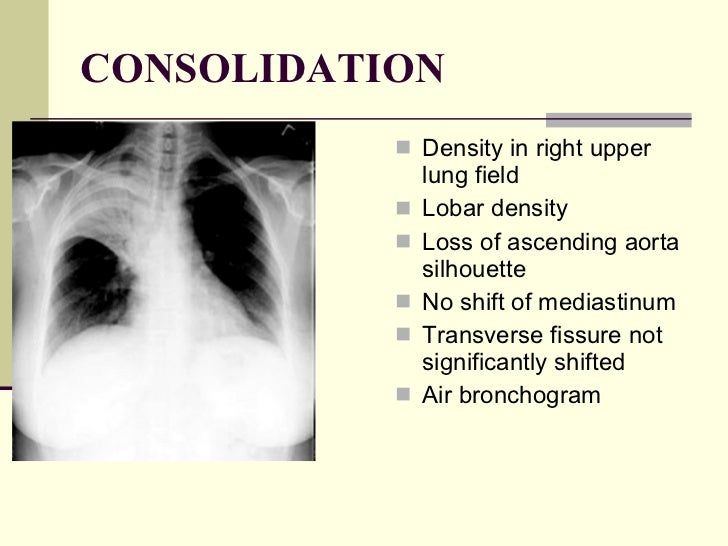 Chest x ray pathology