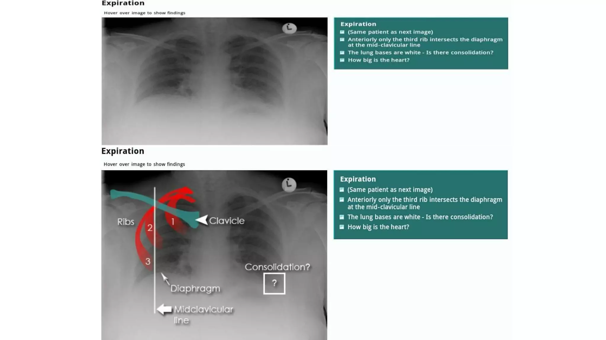 Chest X ray ppt.ppt
