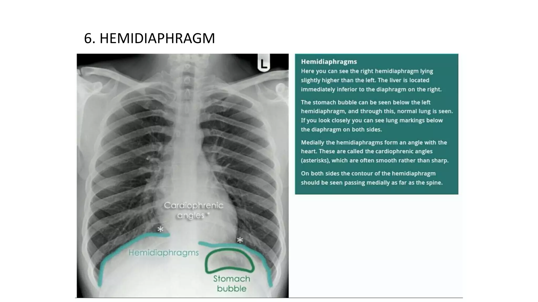 Chest X ray ppt.ppt