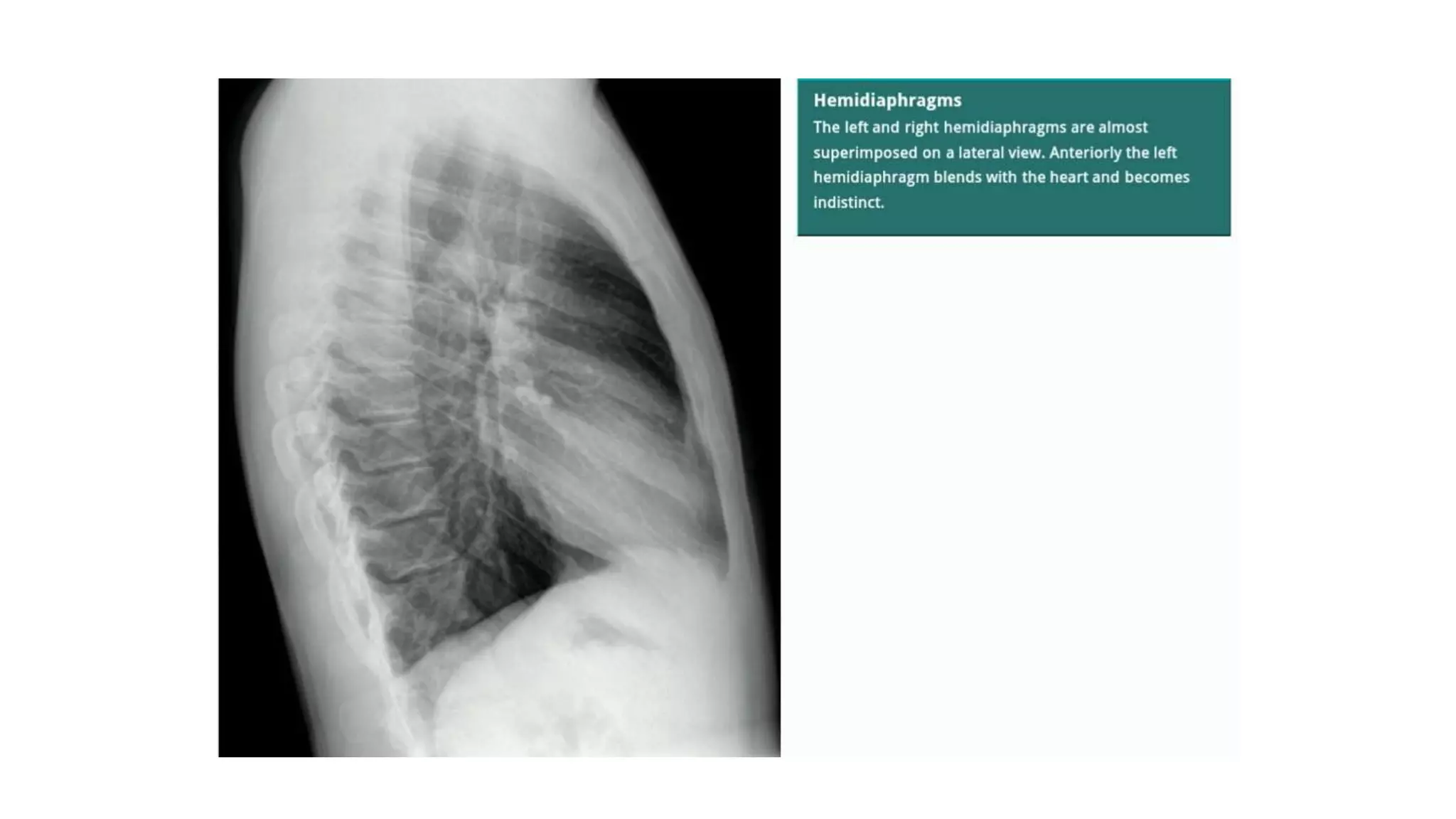 Chest X ray ppt.ppt