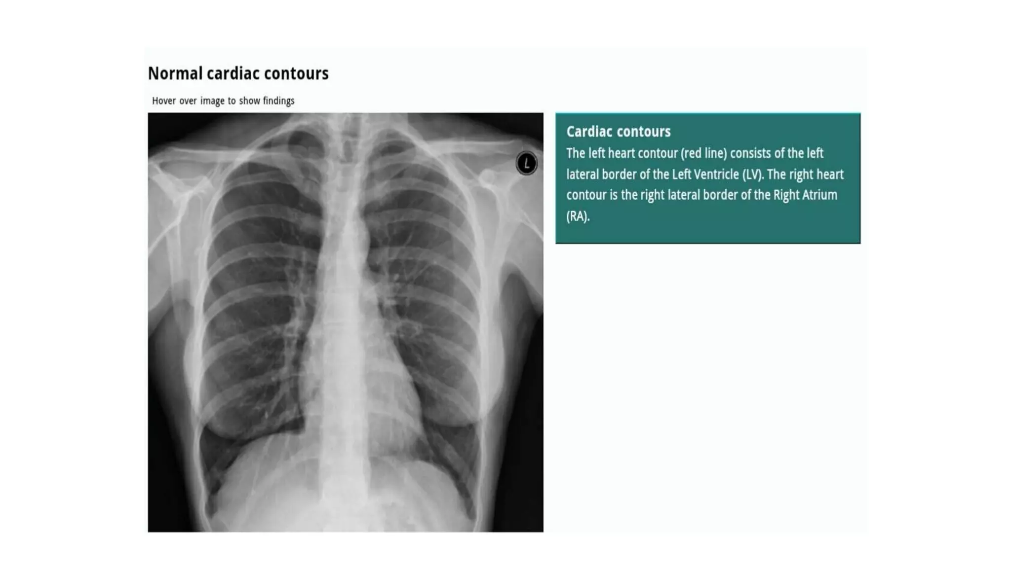 Chest X ray ppt.ppt
