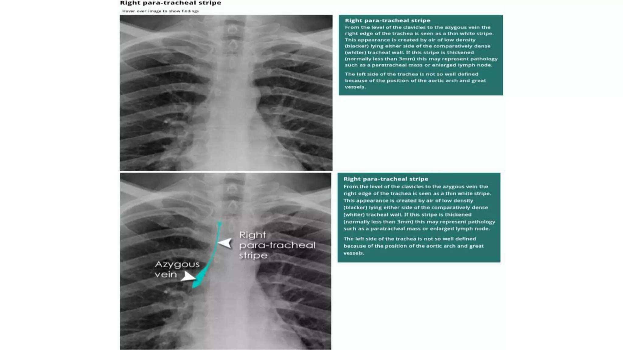 Chest X ray ppt.ppt