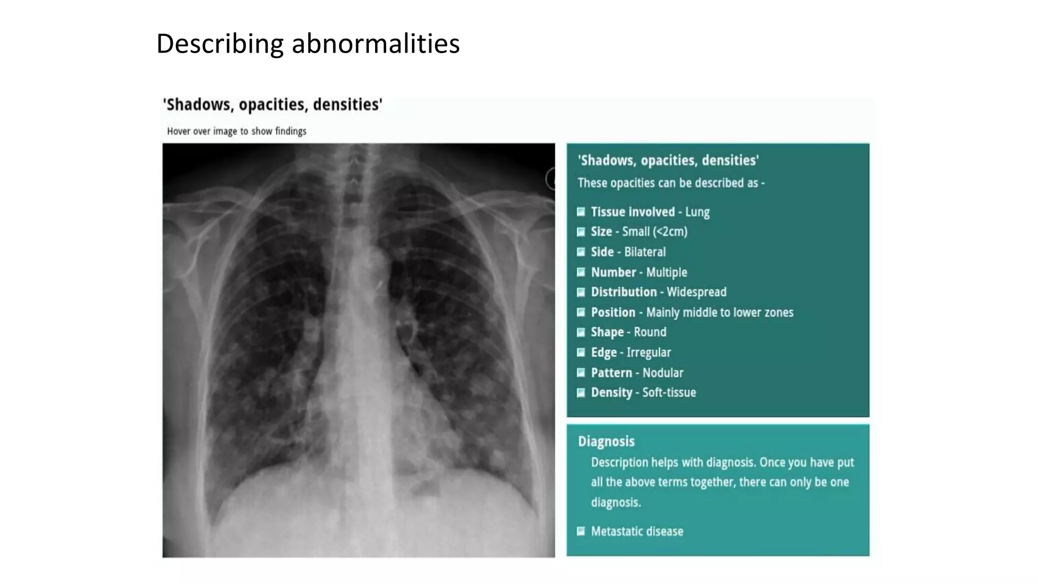 Chest X ray ppt.ppt