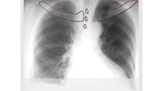 Chest X ray ppt.ppt
