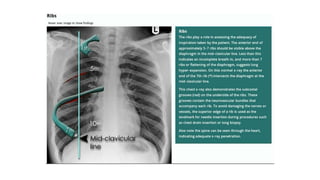 Chest X ray ppt.ppt