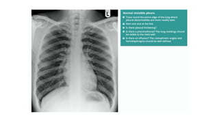 Chest X ray ppt.ppt
