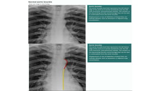 Chest X ray ppt.ppt