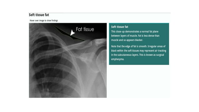 Chest X ray ppt.ppt