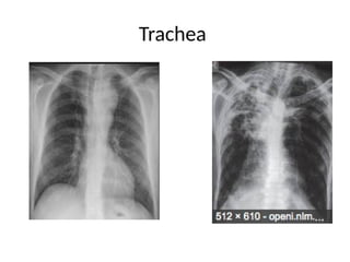 Tracheitis Radiology Imaging in chest radiology Radiographs etc | PPTX