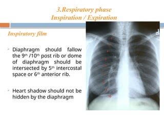 Chest X Ray interpretation Felson radiology.pptx