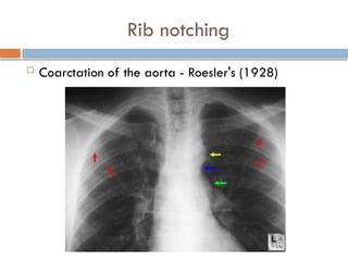 Superior Rib Notching Chest X Ray interpretation Felson radiology.pptx