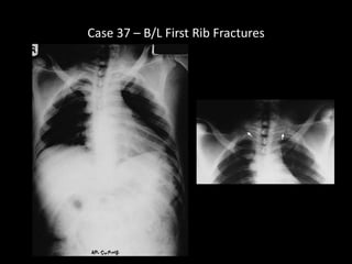 Chest X Rays | PDF