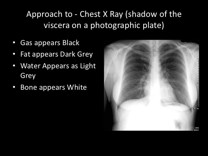 Chest X Rays