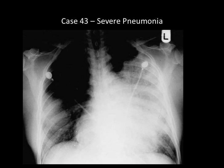 boop pneumonia x rays boop pneumonia x rays
