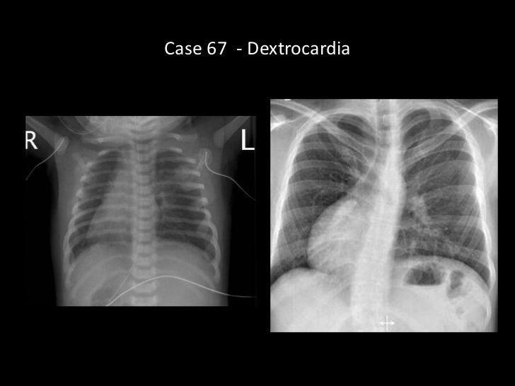 Dextrocardia situs inversus treatment picture
