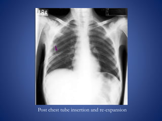 Post chest tube insertion and re-expansion
 