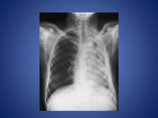 Chest x rays BY Dr Anoop K R