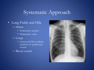 Chest x rays BY Dr Anoop K R