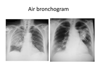 Chest xrays | PPTX