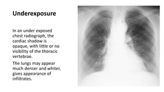 Underexposure
In an under exposed
chest radiograph, the
cardiac shadow is
opaque, with little or no
visibility of the thoracic
vertebrae.
The lungs may appear
much denser and whiter,
gives appearance of
infiltrates.
 