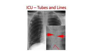 ICU – Tubes and Lines
 