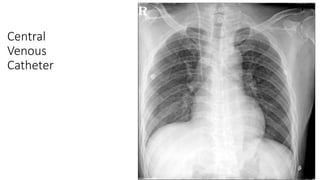 Central
Venous
Catheter
 