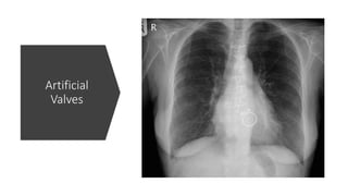 Artificial
Valves
 