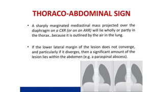 THORACO-ABDOMINAL SIGN
 