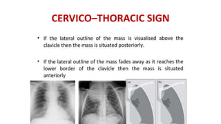 CERVICO–THORACIC SIGN
 
