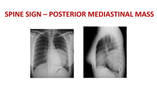 SPINE SIGN – POSTERIOR MEDIASTINAL MASS
 