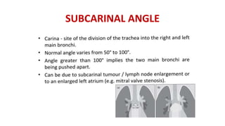 SUBCARINAL ANGLE
 