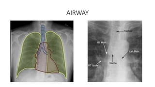 AIRWAY
 