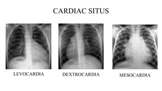 CARDIAC SITUS
LEVOCARDIA DEXTROCARDIA MESOCARDIA
 