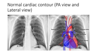 Normal cardiac contour (PA view and
Lateral view)
 