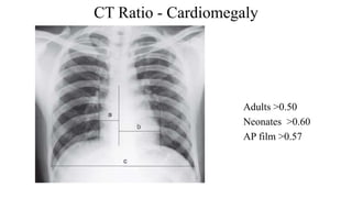 CT Ratio - Cardiomegaly
Adults >0.50
Neonates >0.60
AP film >0.57
 