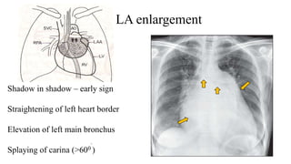 LA enlargement
Shadow in shadow – early sign
Straightening of left heart border
Elevation of left main bronchus
Splaying of carina (>600
.
)
 