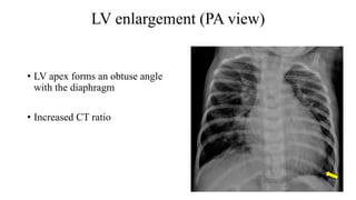 LV enlargement (PA view)
• LV apex forms an obtuse angle
with the diaphragm
• Increased CT ratio
 