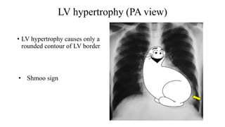 LV hypertrophy (PA view)
• LV hypertrophy causes only a
rounded contour of LV border
• Shmoo sign
 