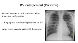 RV enlargement (PA view)
Overall increase in cardiac shadow with a
triangular configuration
Tilting-up and posterior displacement of LV
Apex forms an acute angle with diaphragm
 