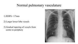 Normal pulmonary vasculature
1
2
3
1) RDPA <17mm
2) Larger lower lobe vessels
3) Gradual tapering of vessels from
centre to periphery
 