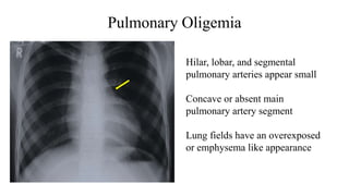 Pulmonary Oligemia
Hilar, lobar, and segmental
pulmonary arteries appear small
Concave or absent main
pulmonary artery segment
Lung fields have an overexposed
or emphysema like appearance
 